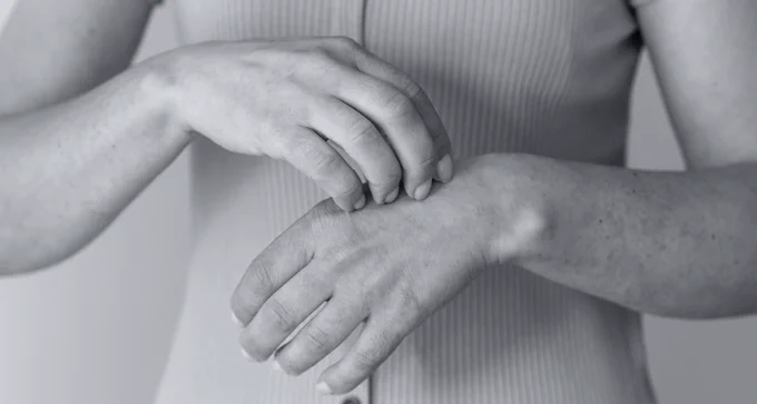 A black and white picture of a woman scratching her hands, symbolising the itchy, debilitating skin condition HS.