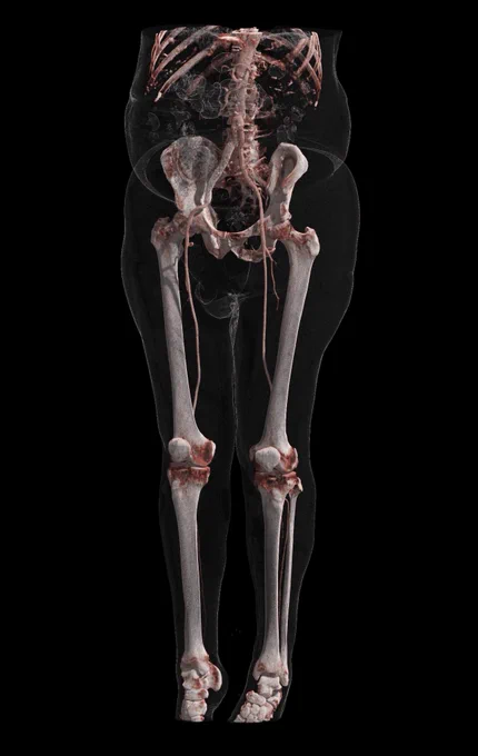 Cinematic Rendering of a CT scan, showing the arteries and skeleton of a human. Made with Horos Mobile