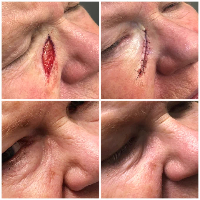 Removal of skin CA.