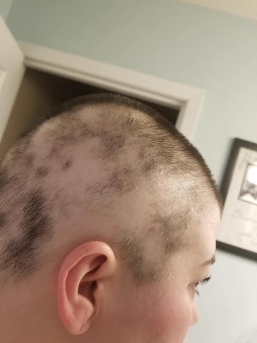 Patient with hair falling out