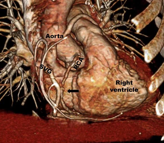 Bypass (arrow) of the mid-right coronary artery (RCA) using a saphenous vein graft (SVG).