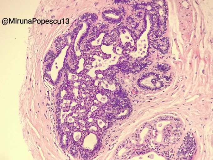 Usual ductal hyperplasia (UDH)