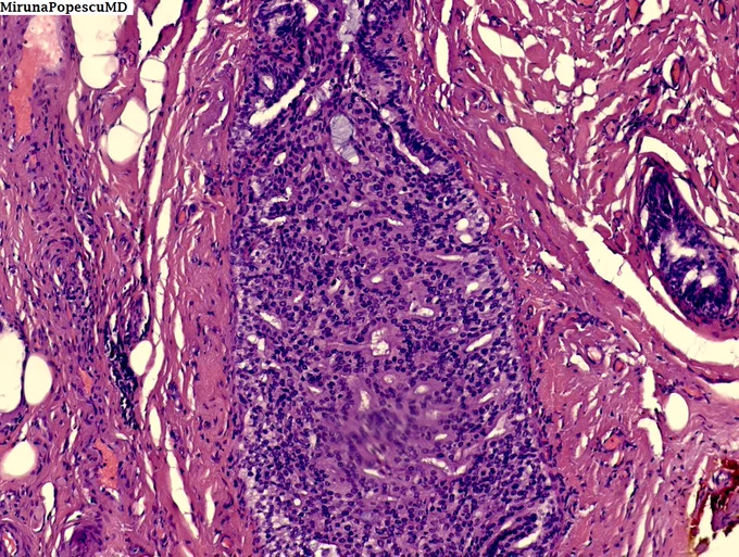 Atypical ductal hyperplasia (ADH)