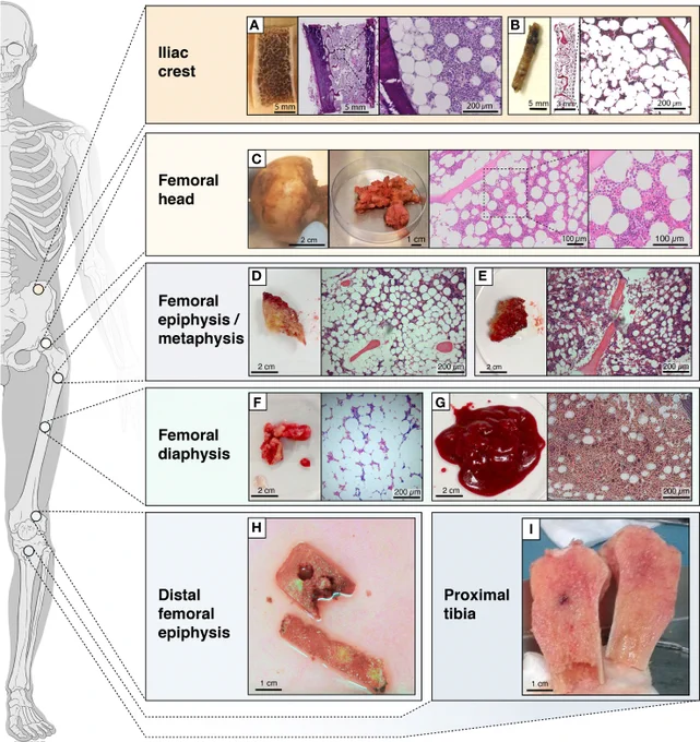 Schematic figure showing the locations from which BMAT is obtained. Locations from which BMAT is obtained, heterogeneity in tissues (e.g. more fatty vs less fatty) and collected fractions. (A) transiliac bone autopsy obtained with a Bordier trephine and (B) iliac bone marrow biopsies obtained with a Jamshidi trephine; (C) femoral head autopsy; (D) epiphyseal or (E) metaphyseal tissue from femur; (F) diaphyseal bone or (G) bone marrow from femur; (H) tissue from the distal femoral epiphysis; (I) bone tissue from the proximal tibia.