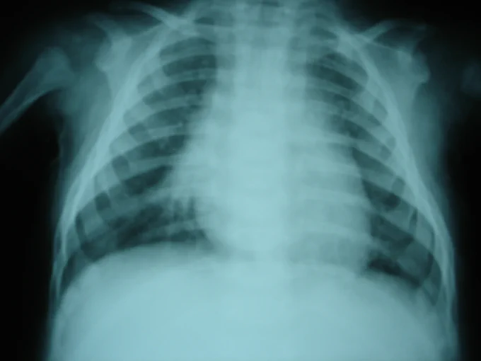 Bronchiolitis x-ray image