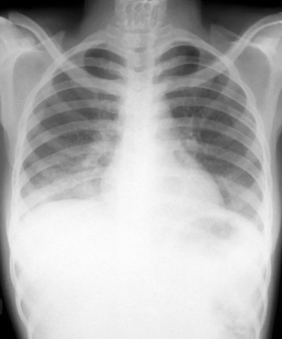 x-ray shows a patient with tuberculosis and HIV