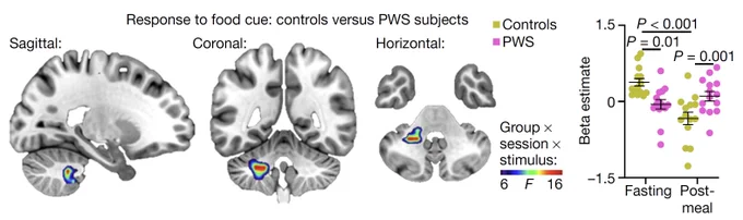 Hunger state-dependent responses to food cues in brains of patients with Prader-Willi syndrome