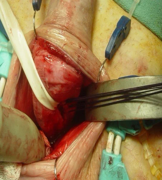 Corporal closure in prep for transcorporal cuff placement