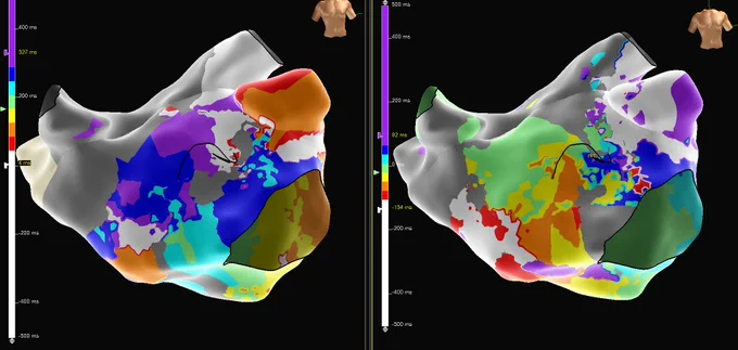 Activation map of 2 clinical ATs, both rendered non-inducible with ablation in previously identified slow conduction zone