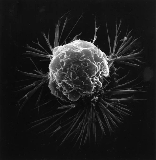 A breast cancer cell, photographed using a scanning electron microscope to produce a 3D image. Image credit: National Cancer Institute (public domain)
