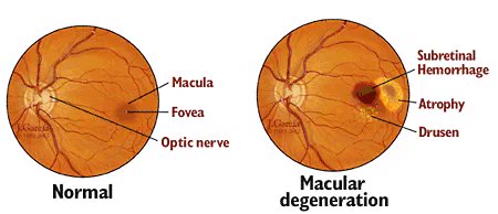 Patients with age-related macular degeneration have central blurred vision, metamorphopsia and change in color perception, making it especially difficult for patients to read and recognize faces. The See Far smart glasses, adapts to the needs of users and optimize their vision through the use of a personalized visual assistant that captures the condition of the eye, detect the problem, and provides the appropriate adjustment through the integration of reality technologies. By configuring the See Far smart glasses patients with AMD can magnify images and texts to reduce the perceived central scotoma, better illuminate specific areas. Augmented reality technology can also be used for recognition of warning of obstacles or dangers during walking around.
Through the notifications offered by the See Far mobile application, the user will receive specific reminders about the most appropriate diet for the specific pathology, as well as recommendations for healthy living. The See Far smart glas