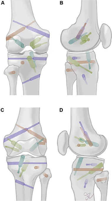 Illustration of all MLKI sockets and tunnels created for assessment in the present study from posterior (A), medial (B), anterior (C), and lateral (D) perspectives. MLKI, multiligament knee injury. (Image Courtesy: used with permission from The Curators of the University of Missouri).|