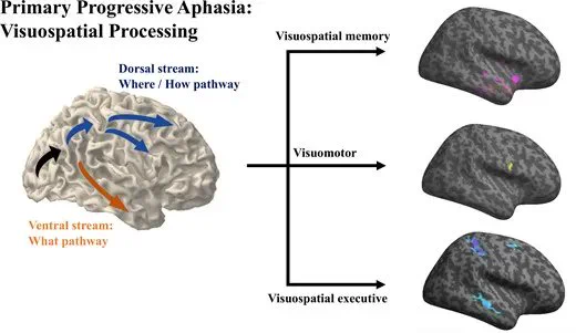 Primary progressive aphasia visuospatial processing.