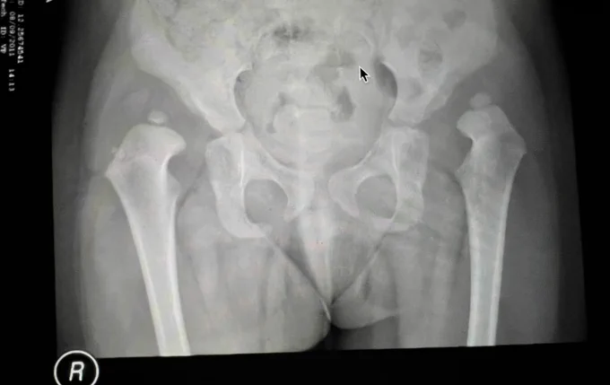 28 months late dislocation