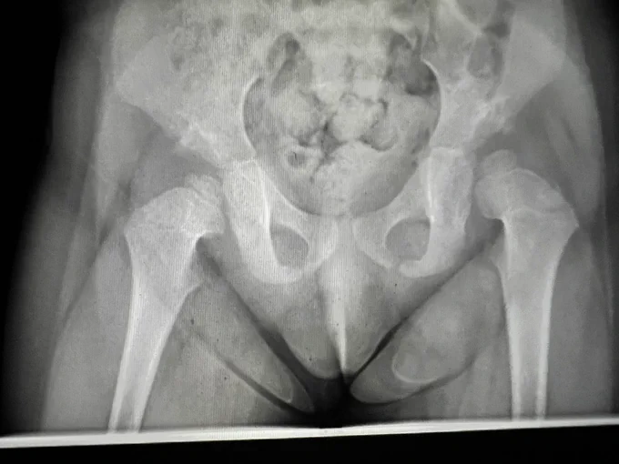1 year post mor, acetabular remodelling