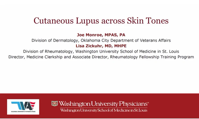 Health care providers may be unaware of the clinical
integration of pattern of cutaneous lupus with interpretation of
autoimmune serologic studies to determine differential risk of
systemic lupus.