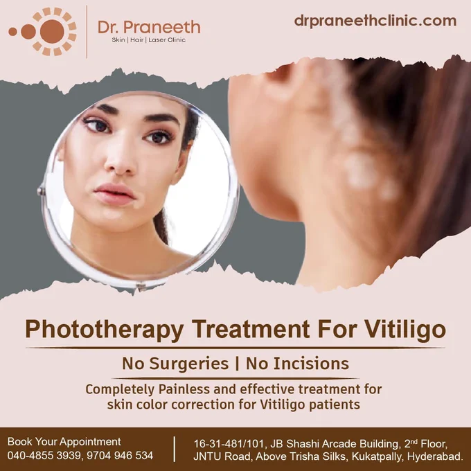 Vitiligo Treatment 