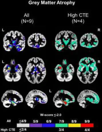 Common regions of grey matter atrophy in patients with RHI and TES.