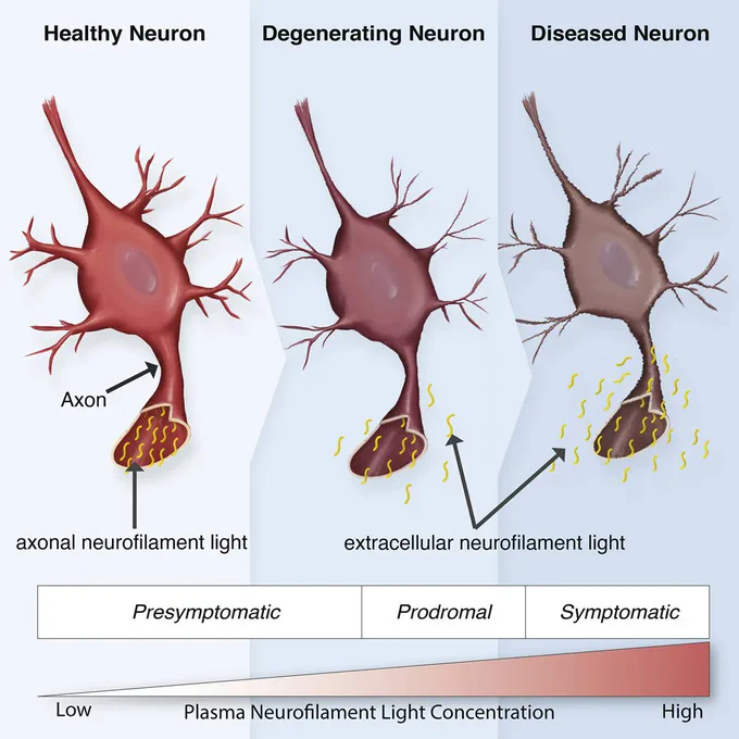 Graphical abstract showing neurofilament light in a healthy neuron, degenerating neuron and a diseased neuron.