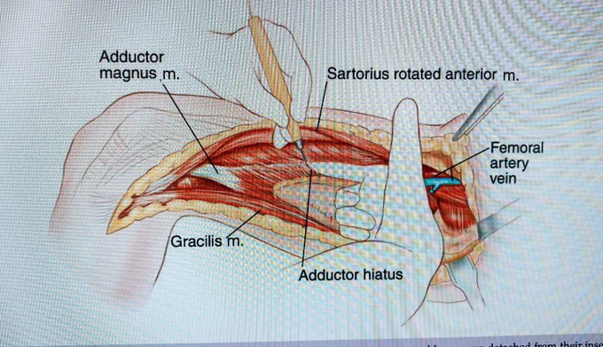Malawer medial compartment resection of the tight
