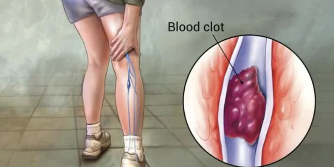 diagram of blood clot in leg