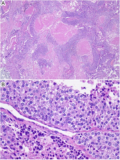 Fig 1 - Poorly differentiated thyroid carcinoma: a clinician's perspective