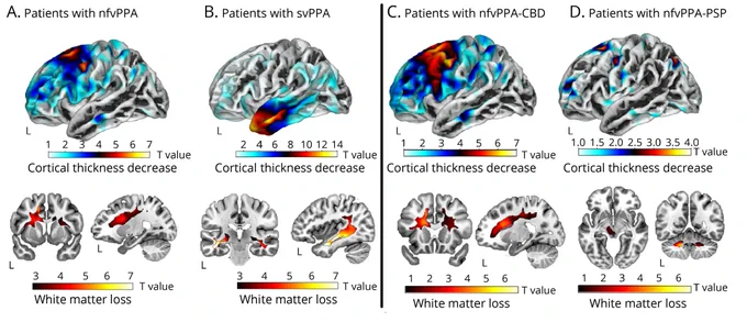 Brain structural abnormality patterns of each patient group.