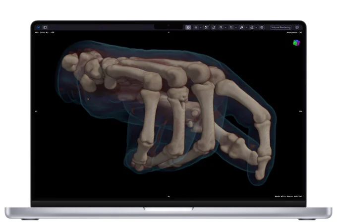 Depiction of a photorealistic 3D rendering of a Hand CT scan on a 16’ MacBook Pro 5th Generation. Soft tissues and bones are presented in an unparalleled detail along with the tendons of the hand.