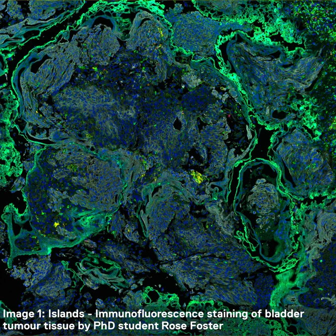 Image 1: Islands – Immunofluorescence staining of bladder tumour tissue by PhD student Rose Foster.