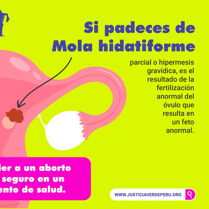 Si padeces de Mola hidatiforme parcial o hipermesis gravídica, es el resultado de la fertilización anormal del óvulo que resulta en un feto anormal, puedes acceder a un aborto terapéutico seguro en un establecimiento de salud.