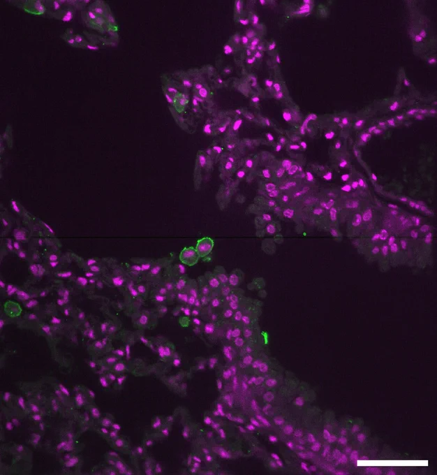 Melanoma cells (green) in cleared mouse lung tissue. Magenta represents all cell nuclei.