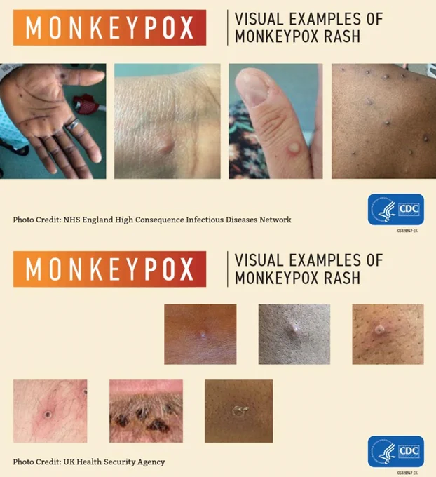 Visual depictions of Monkeypox rashes, which can appear as pimples or blisters. The photos are credited to the NHS England High Consequence Infectious Diseases Network and the UK Health Security Agency. 