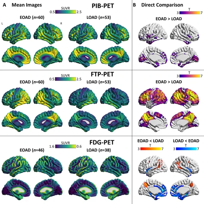Mean images and group comparisons of biomarkers. (A) Mean interpolated surface projections of average SUVR maps are displayed for EOAD and LOAD subgroups for PIB-PET, FTP-PET, and FDG-PET. (B) Voxel-wise comparisons between groups, with significant differences.