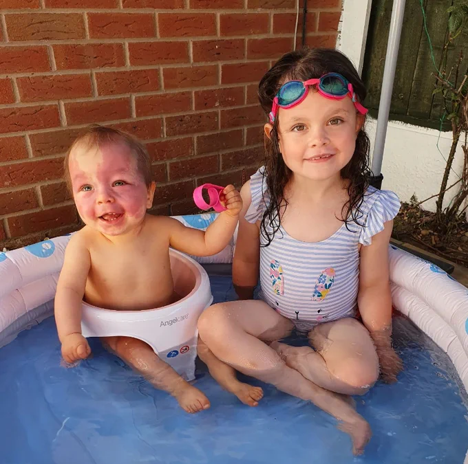 Lily and her big sister, Chloe, sat in a paddling pool. Chloe is about six years old, with long brunette hair. She's wearing goggles on her head. Lily is a baby with a port wine stain that covers most of her face. She's smiling up at the camera - a cheeky grin!