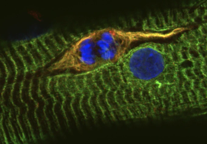 dividing satellite cell on the surface of a regenerating human myofibre; nestin red, desmin green, nuclei blue