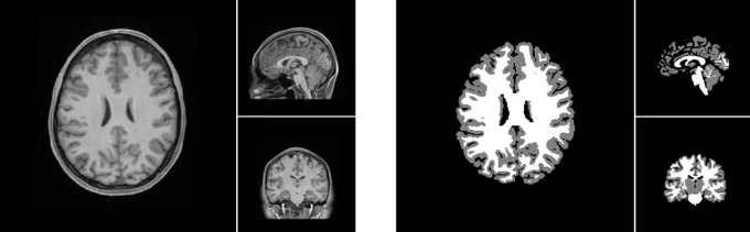 Black and white image of a brain MRI. 