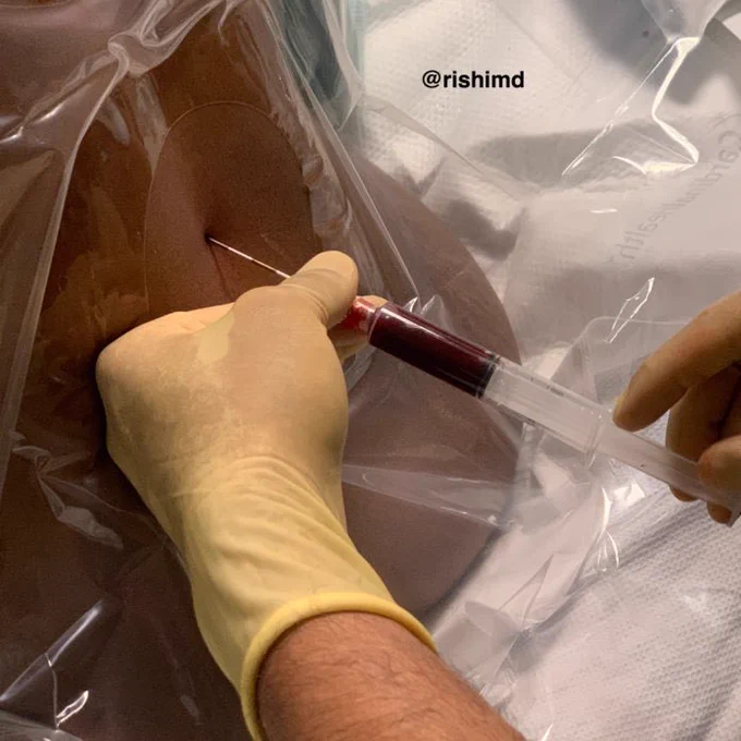 Epidural blood patch procedure