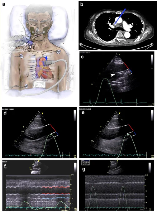 a Diagram of probe position required for identification of the superior vena cava (SVC). 
b Chest computerized tomography showing orientation of the image plane required for identification of the SVC. 
c Visualization of a central venous catheter positioned in the SVC (white arrow) with the aorta indicated by a red line, the SVC by a blue line, and the vessel walls highlighted with white lines. 
d Visualization of the SVC and aorta without agitated saline contrast injection with the SVC and aorta indicated as in (c) and the SVC indicated by an asterisk. 
e Identical view of the SVC and aorta as in (d) following injection of agitated contrast injection resulting in opacification of the SVC. 
f M-mode visualization of the SVC demonstrating significant respirophasic diameter variation with the SVC outlined in blue and the aorta in red. 
g M-mode visualization of the SVC demonstrating minimal respirophasic diameter variation.
