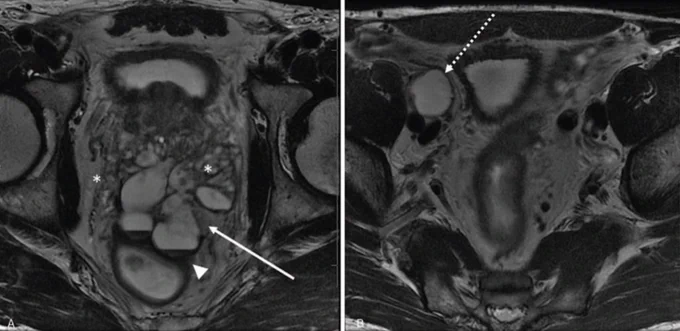 Case of mucinous prostatic adenocarcinoma, from Horvat et al. Uncommon Prostate Malignant Neoplasms. Topics in Magnetic Resonance Imaging: February 2020 - Volume 29 - Issue 1 - p 31-45 doi: 10.1097/RMR.0000000000000230