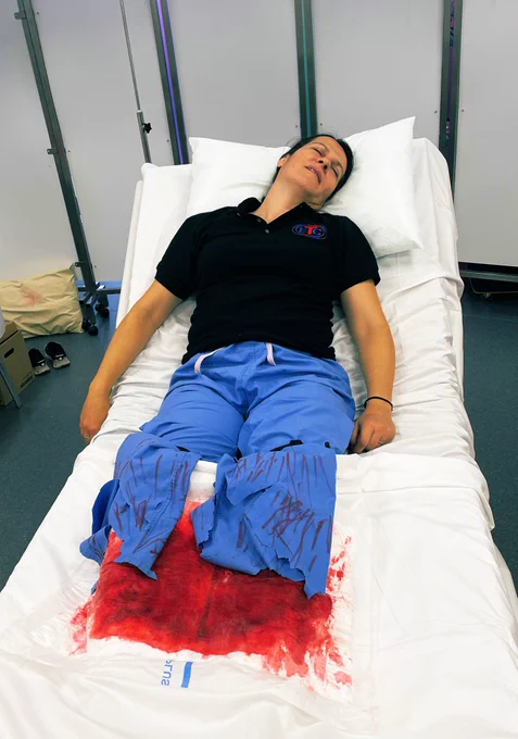 Simulation of bilateral below knee amputation.