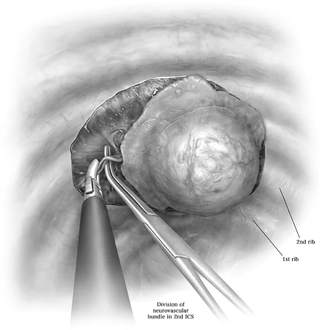 [Excerpt]: Following port placement, the lung is mobilized away from the chest wall tumor. Any dense adhesions to the parietal pleura are taken down cautiously with blunt dissection to fully visualize the width of the chest wall tumor or extent of chest wall invasion. For resection of primary chest wall tumors, unless the adherent lung is clearly only innocently adherent (with filmy adhesions), a small wedge resection of lung should be included to avoid the risk of violating the tumor and spreading tumor into the pleural space. Once the lung is adequately mobilized, circumferential marginal excision of parietal pleura around the tumor is scored using electrocautery. Adjacent areas along the chest wall are also inspected for presence of any additional lesions. Once the parietal pleura is incised circumferentially, the underlying ribs are exposed. Most often, the ribs are exposed from the most superior border to the furthest inferior border and circumferentially to facilitate resection.