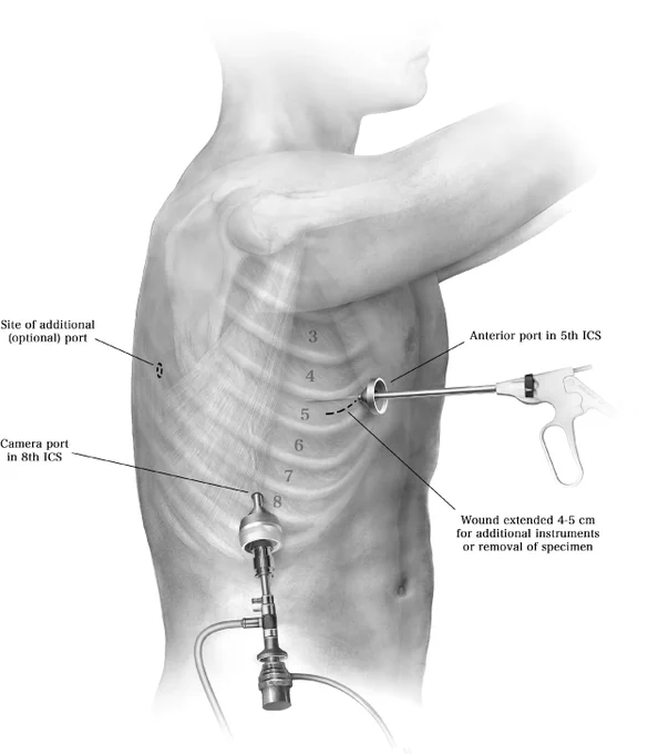 The basic tenets of VATS chest wall resection in terms of patient positioning are similar to those of standard VATS procedure for lung resection. Preoperatively, an epidural for chest wall resection is placed. Following successful induction and lung isolation, patient is placed in the lateral decubitus position (with appropriate padding) with the table break maximally flexed at the patient's hip level. Reverse Trendelenburg is used to tilt the table such that the patient's lateral chest wall is in line and parallel to the floor. The table may be rotated to facilitate exposure.