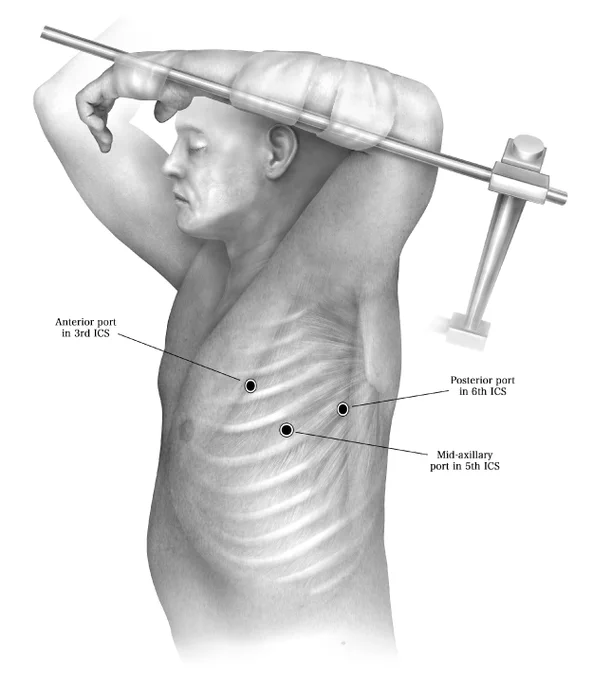 Tumors of the chest wall at the apex requiring resection of the first rib are particularly challenging to manage thoracoscopically due to limited visualization at the apex of the thorax and difficulty of dissection near the thoracic outlet. If amenable to VATS resection, the ports can be placed as shown below: one at the anterior axillary line (Third intercostal space), one at the mid axillary line (Fifth intercostal space) and one in the Sixth intercostal space along the posterior axillary line.