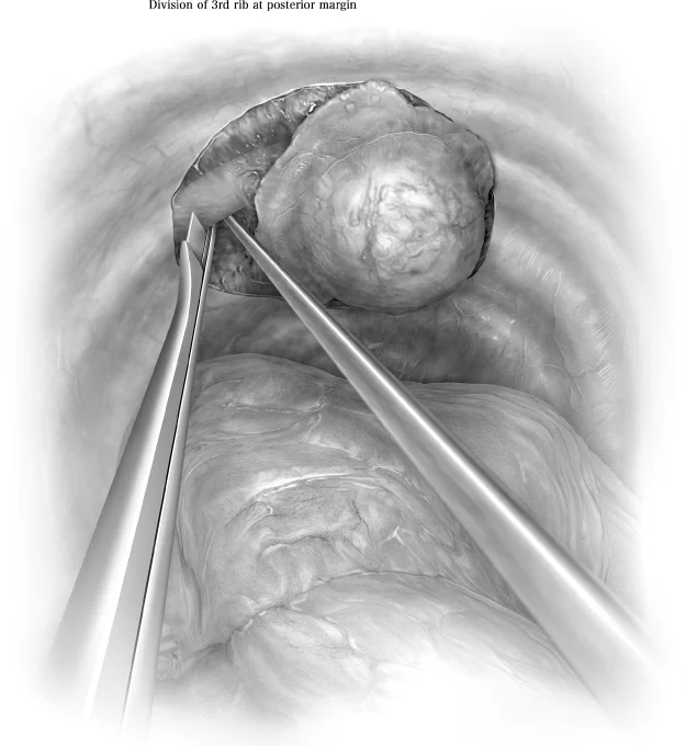 Once the ribs are exposed, the posterior border of the ribs are divided using various instruments such as the rib cutter, long peapod intervertebral disc rongeur, long-handled rib shears (Giertz rib shears) or endoscopic osteotomes (Table 1). Since cutting the posterior rib attachment can be tedious because of increased depth and proximity of multiple bony elements, which may make insertion of bone cutting forceps difficult, an extended length 4 mm burr on a high-speed drill could be useful. If the ribs are adjacent to the sternal border, the costovertebral joints can be disarticulated if needed with an osteotome, allowing thoracoscopic visualization and control of vessels and nerves sequentially. For chest wall tumors near the utility incision, endoscopic osteotomes can be used since they have the most perpendicular angle with the ribs.