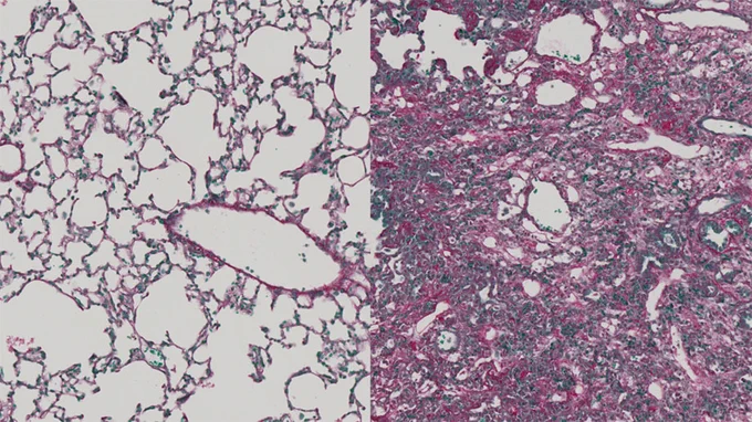Air-filled alveoli in healthy lung tissue on the left, versus fibrotic tissue on the right.