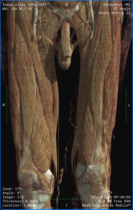 Detailed muscle anatomy of a CT scan of the lower legs, rendered with Horos Mobile rendering machine on iPhone 14 Pro Max