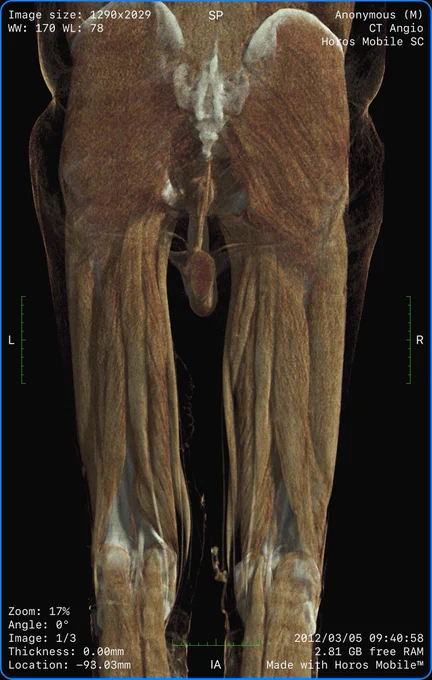 Detailed muscle anatomy of a CT scan of the lower legs, rendered with Horos Mobile rendering machine on iPhone 14 Pro Max