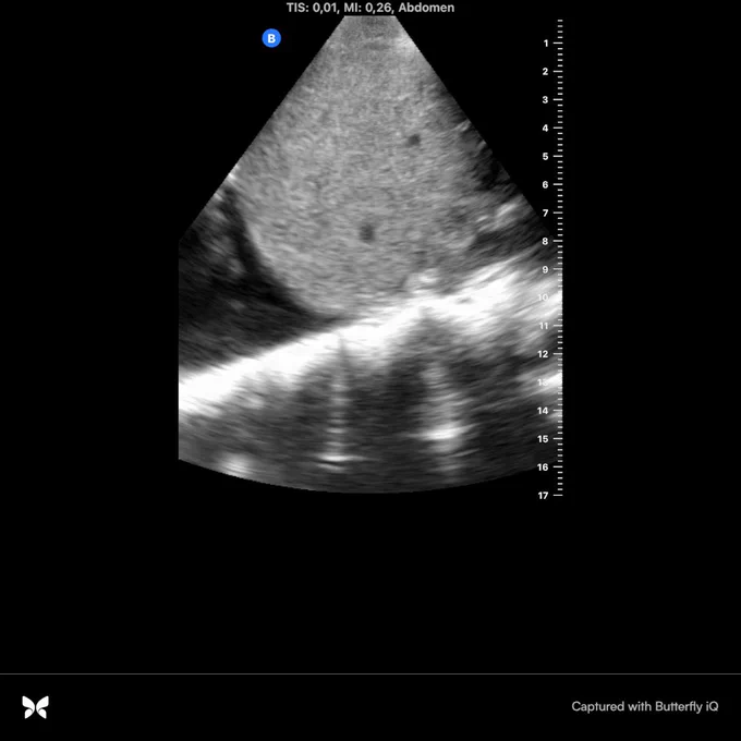 Visualisation of the vertebral bodies above the liver and diaphragm indicates a right pleural effusion. A normal air-filled lung doesn’t transmit sound waves so the vertebral bodies stop at the diaphragm. But fluid transmits the sounds waves so the pleural effusion allows us to see the vertebral bodies above the diaphragm.