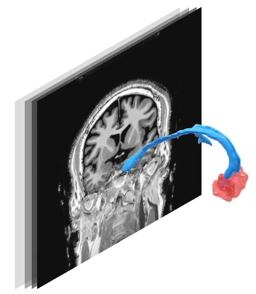 3D rendering of the hypothalamus and fornix in front of an image obtained using Magnetic Resonance Imaging (MRI).