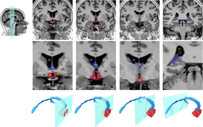 Hypothalamus and Fornix labelled in magnetic resonance images. Both structures are small and situated deep inside the brain.